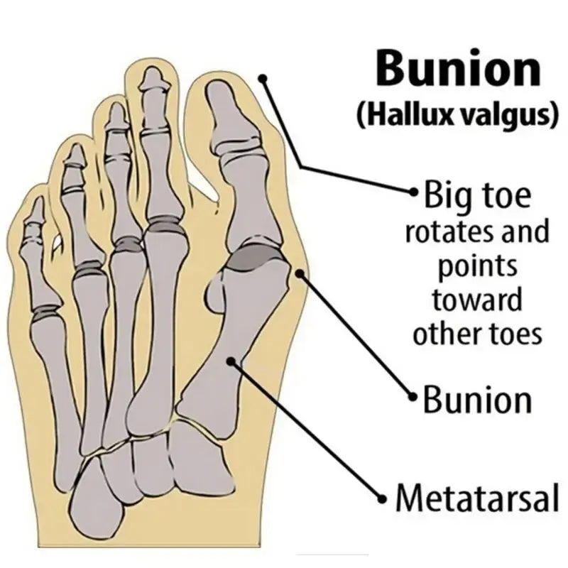 1 Pair Super Elastic Bunion Corrector